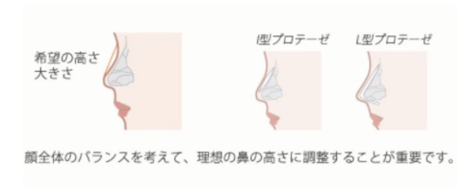鼻プロテーゼのイメージ